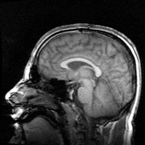 Sagittal brain MRI